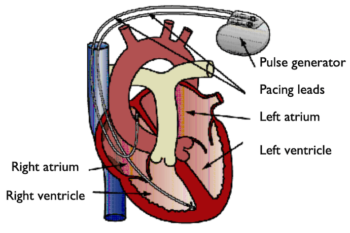 A schematic of a heart with two pacemaker electrode pairs.