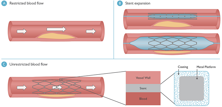 图示说明支架如何在被斑块堵塞的血管中工作。