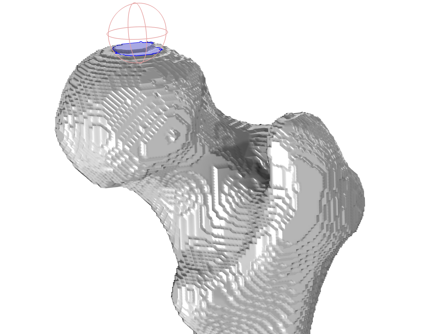 股骨顶部网格的特写，使用带球分割操作划分出大致圆形的边界。