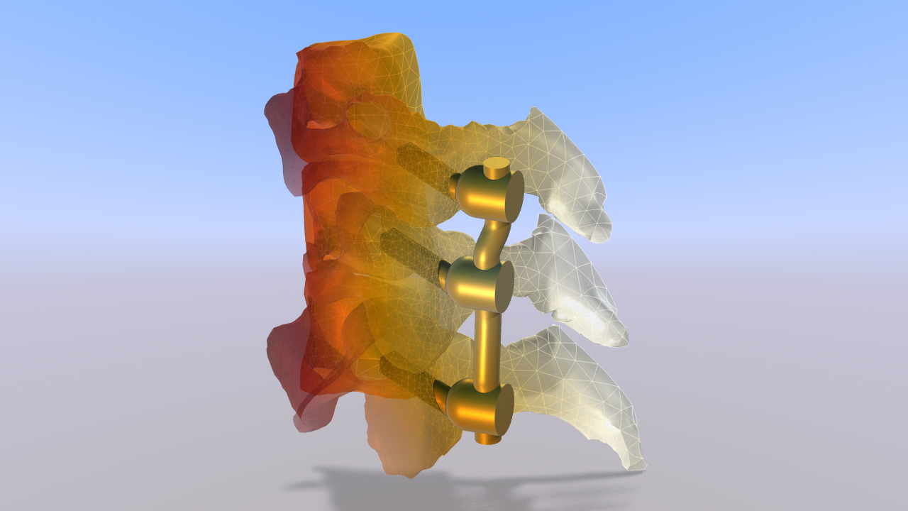 A screw implant model showing the RF-induced heating.