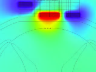 Scar under left electrode reduces proper field symmetry. Image Courtesy: Lahey