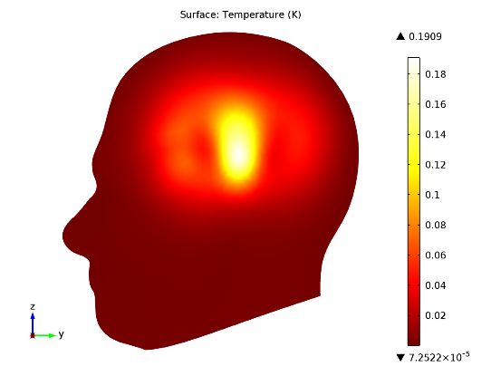 Specific absorption rate (SAR) in the human brain, local increase in temperature