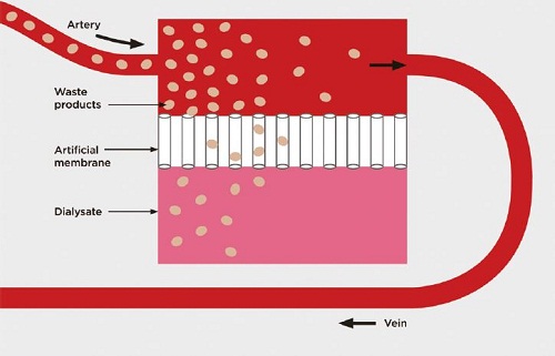 Schematic diagram of a dialyzer design