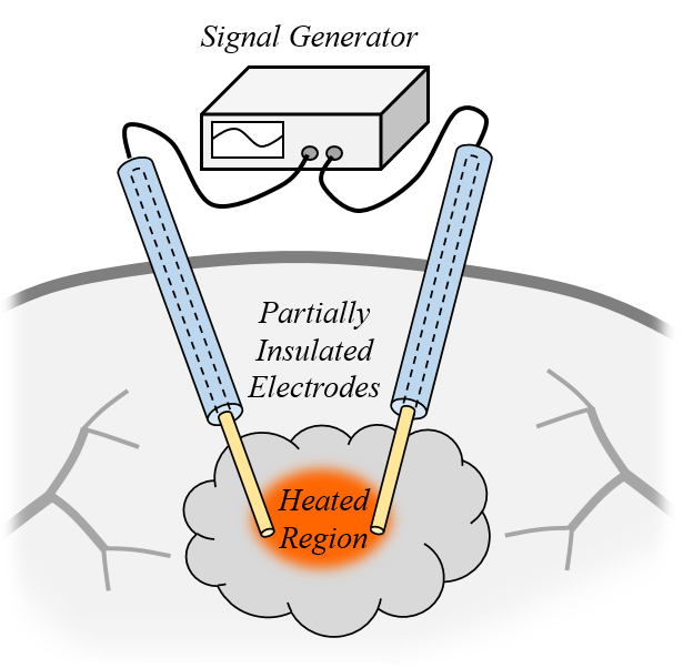 A schematic of a bipolar radiofrequency applicator on the surface of the skin.
