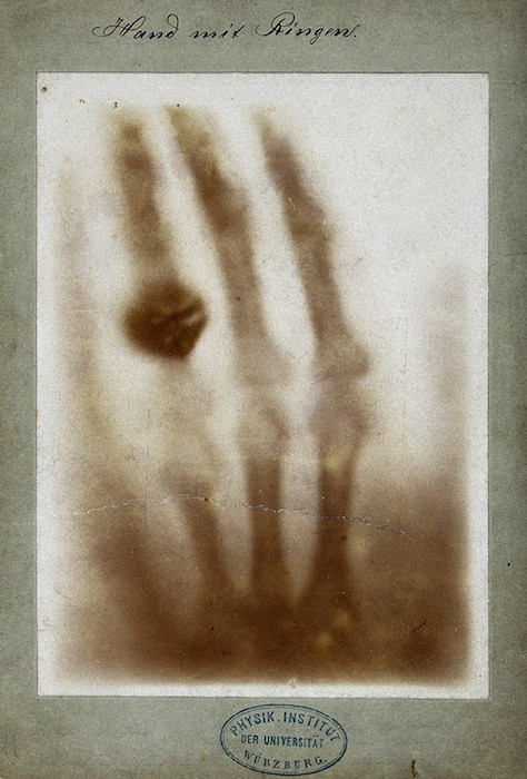 A photograph showing the first X-ray, which is of a hand.