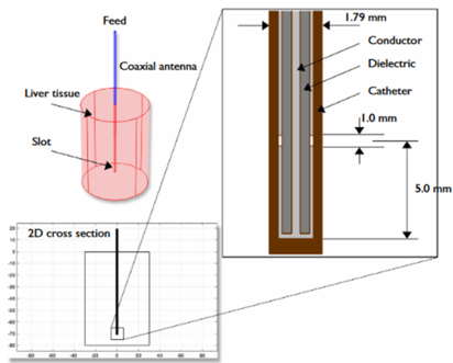 A schematic showing a microwave ablation procedure for a cancerous tumor.