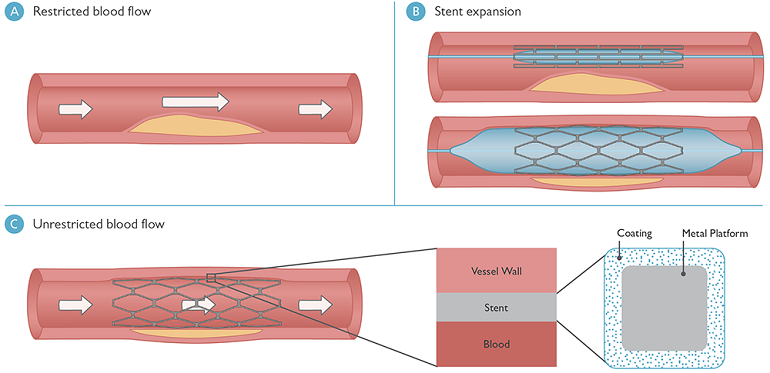 An illustration highlighting how a stent works in a blood vessel blocked by plaque.