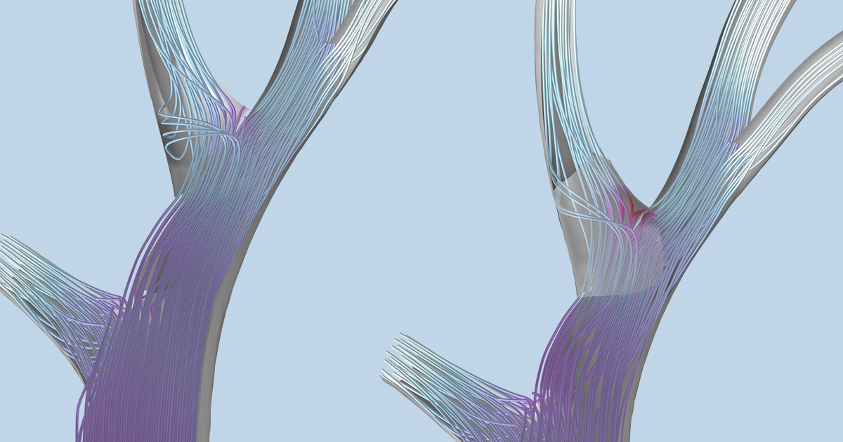 Modeling Blood Flow in a Stenosed Pulmonary Artery | COMSOL Blog